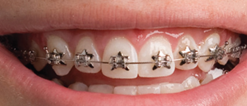 Types of braces at Dr. Zoey Orthodontics in Vero Beach, FL